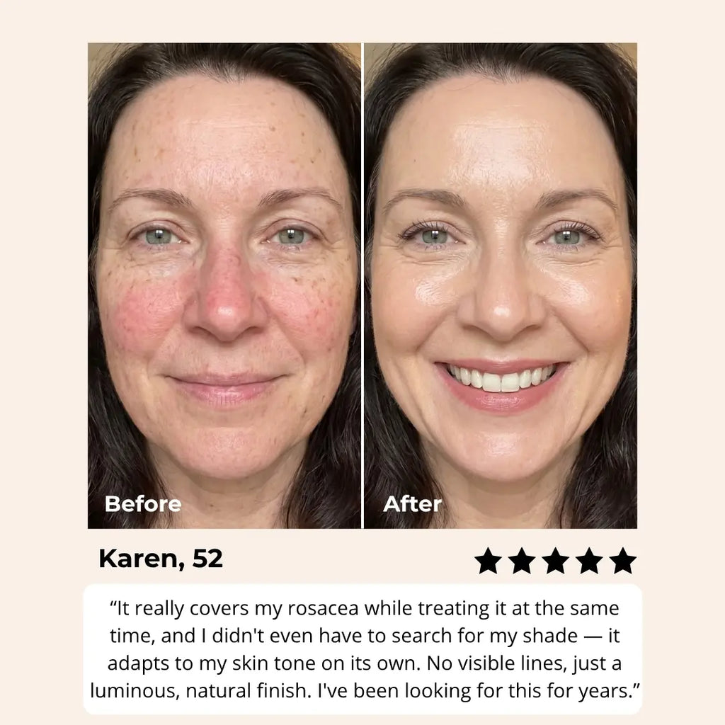Changing Foundation For Rosacea