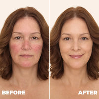 Changing Foundation For Rosacea